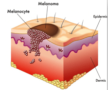 Melanoma Structure