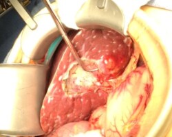 Removed In Order To Then Resect Tumor Shown